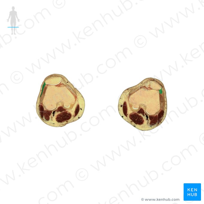 Retinaculum patellae laterale (Äußeres Halteband der Kniescheibe); Bild: National Library of Medicine