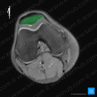 Patella (Kniescheibe); Bild: 