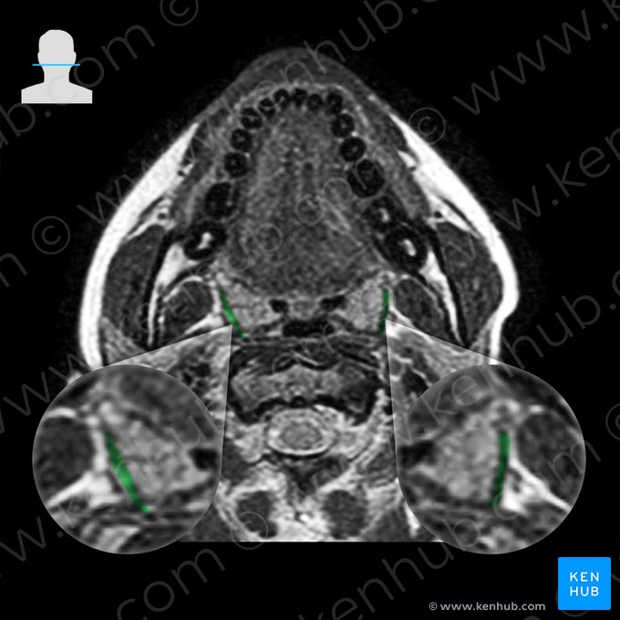 Superior pharyngeal constrictor muscle (Musculus constrictor pharyngis superior); Image: 