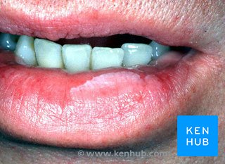Leukoplakia