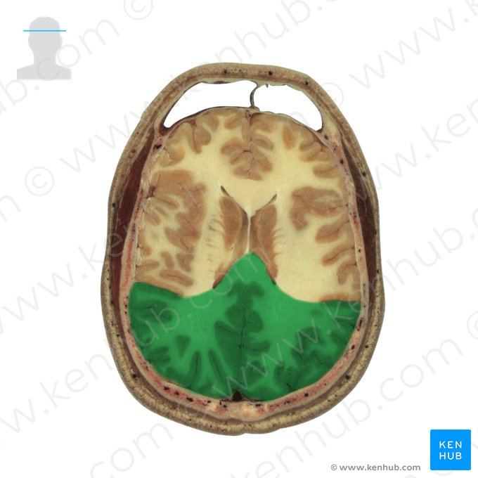 Parietal lobe (Lobus parietalis); Image: National Library of Medicine