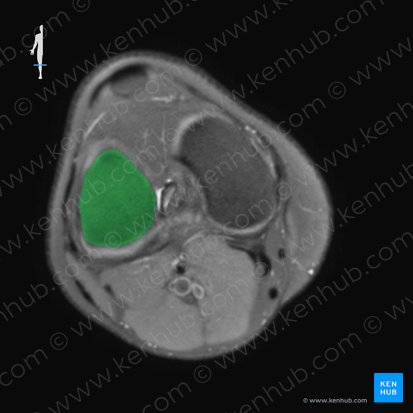 Lateral condyle of femur (Condylus lateralis ossis femoris); Image: 