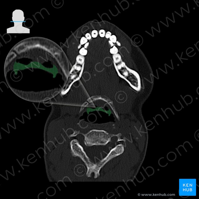 Epiglote (Epiglottis); Imagem: 