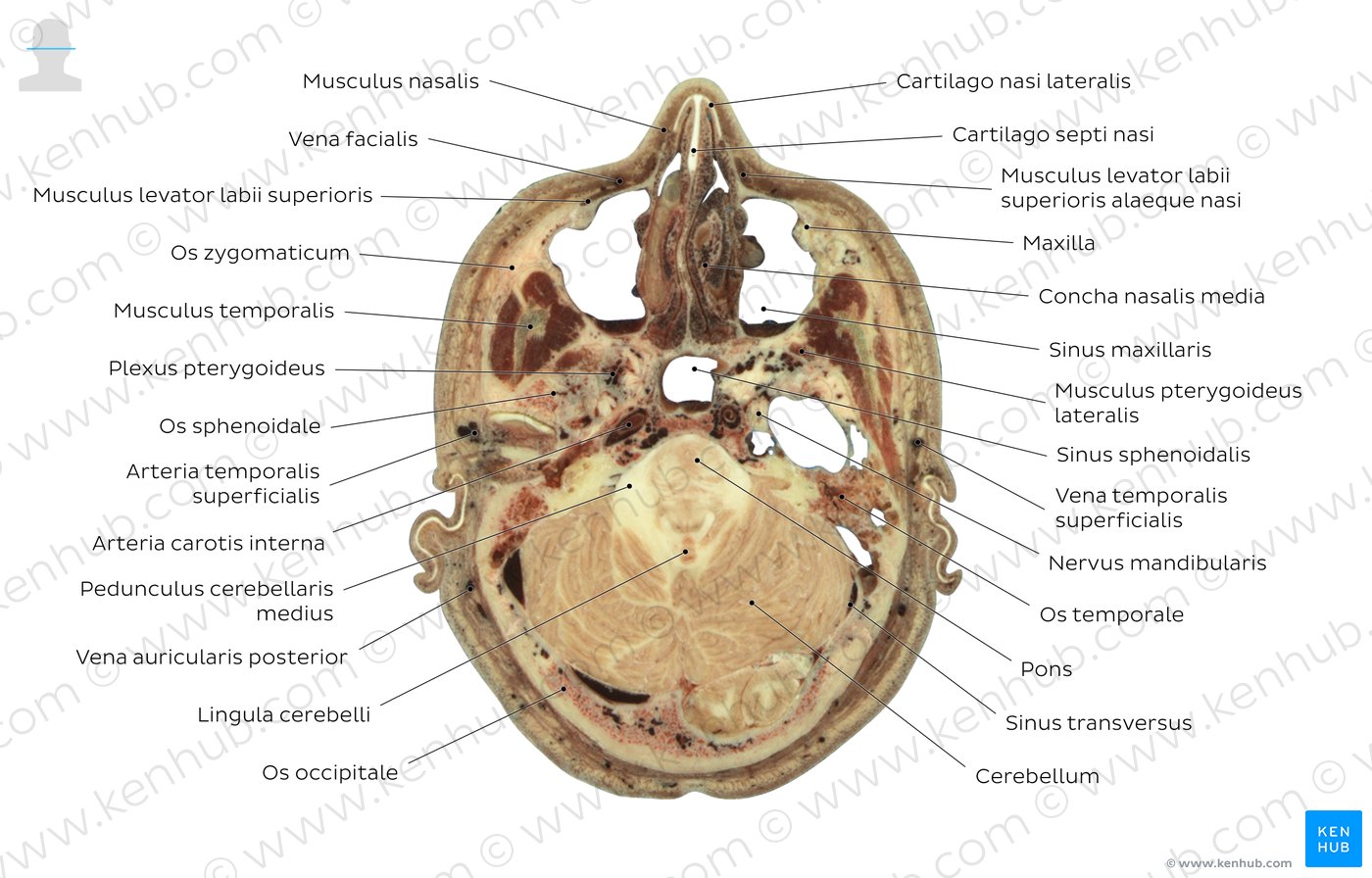 Schnittbild auf Höhe des Sinus maxillaris