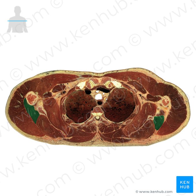 Teres minor muscle (Musculus teres minor); Image: National Library of Medicine