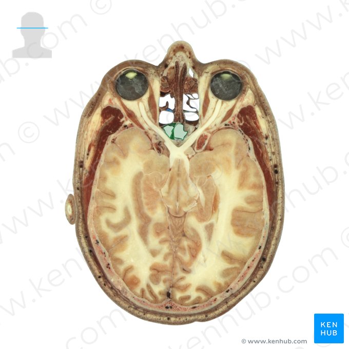 Sphenoidal sinus (Sinus sphenoidalis); Image: National Library of Medicine
