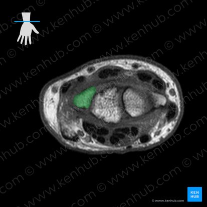 Triquetrum bone (Os triquetrum); Image: 