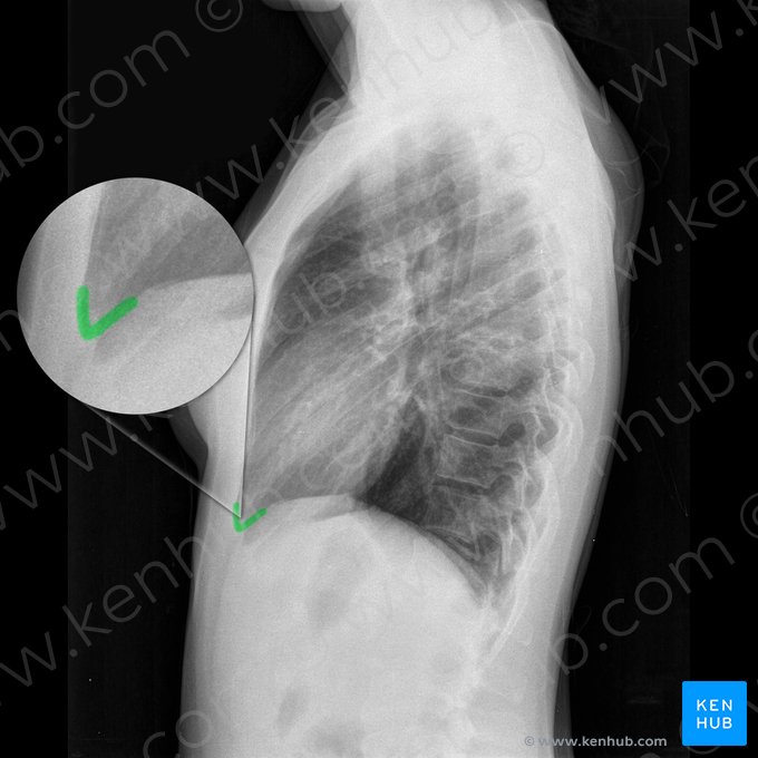 Angulus costophrenicus anterior dexter (Rechter vorderer Zwerchfellrippenwinkel); Bild: 