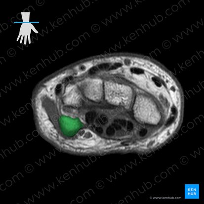 Pisiform bone (Os pisiforme); Image: 