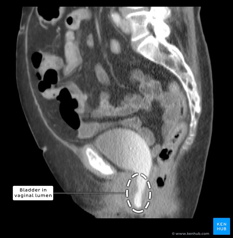 Sagittal CT of a cystocele