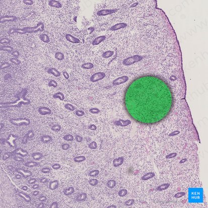 Stromal edema; Image: 