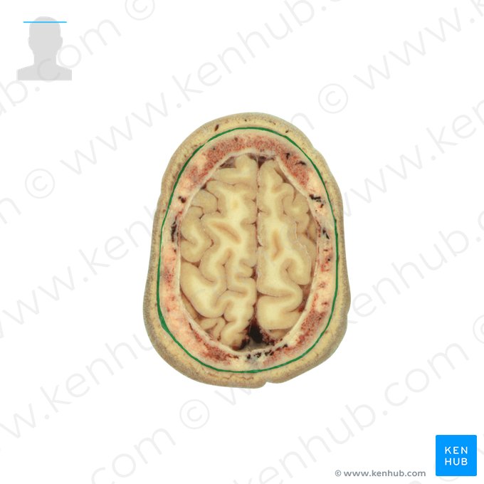 Frontalis muscle & epicranial aponeurosis (Musculus frontalis & galea aponeurotica); Image: National Library of Medicine