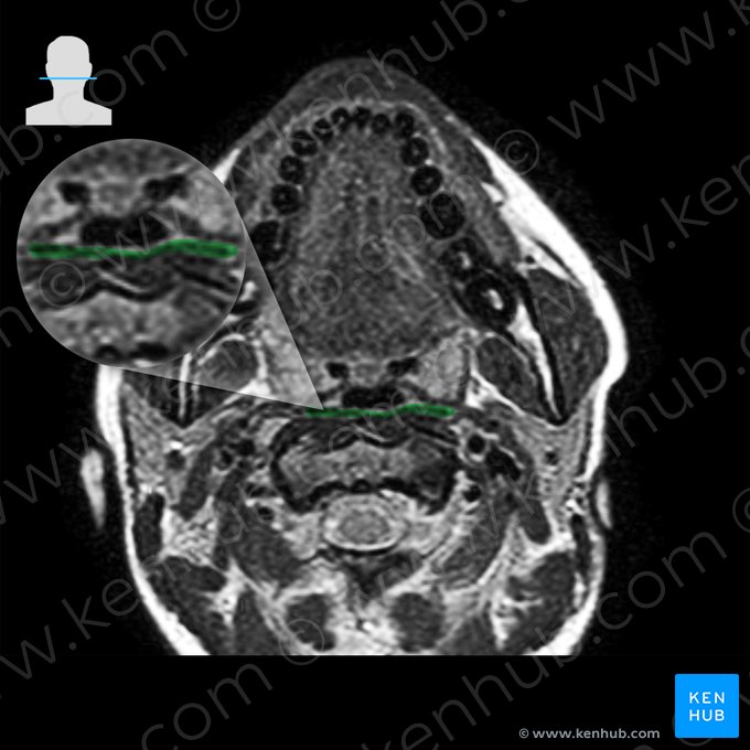 Músculo constritor médio da faringe (Musculus constrictor medius pharyngis); Imagem: 