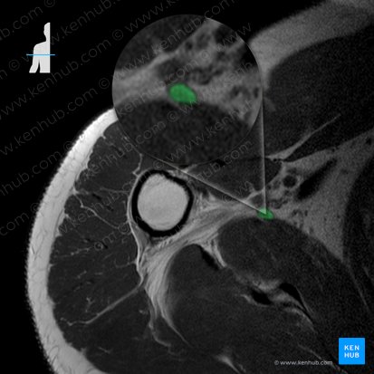 Subscapular artery (Arteria subscapularis); Image: 