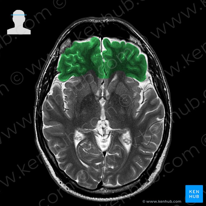 Lobus frontalis (Stirnlappen); Bild: 