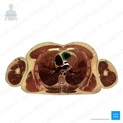 Right ventricle of heart (Ventriculus dexter cordis); Image: National Library of Medicine