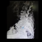 Clinical Case: Degenerative Sacrolisthesis