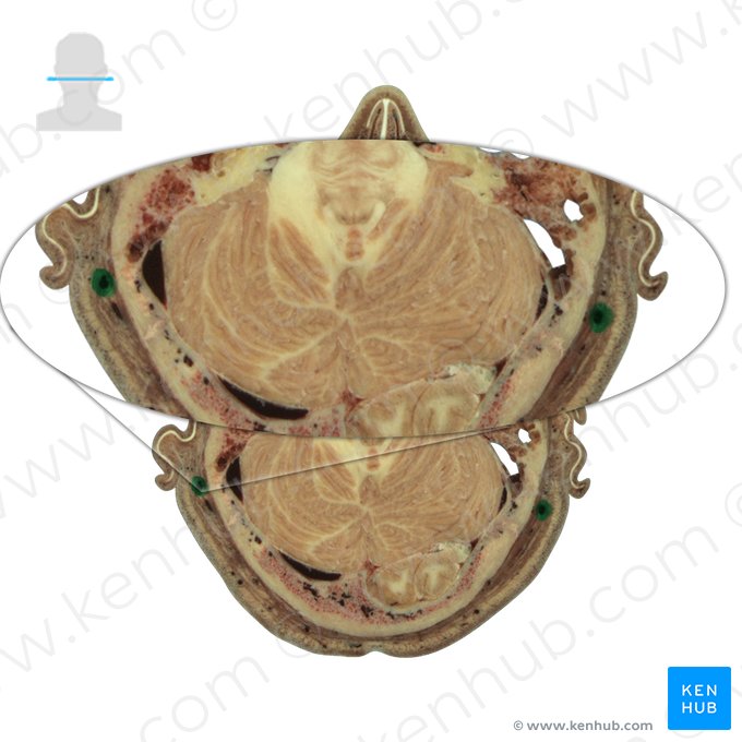 Veia auricular posterior (Vena auricularis posterior); Imagem: National Library of Medicine