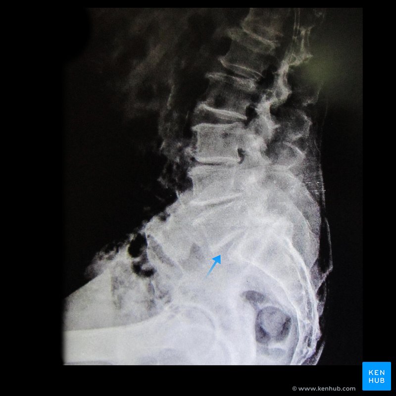 Spondylolisthesis at the S1/S2 junction - lateral view