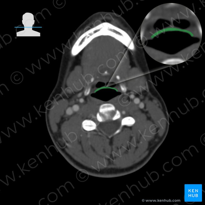 Epiglottis (Kehldeckel); Bild: 