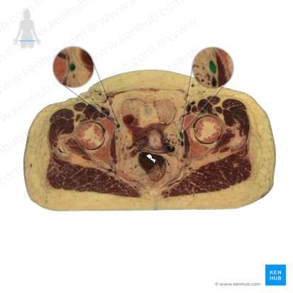 Arteria iliaca interna (Innere Beckenarterie); Bild: National Library of Medicine