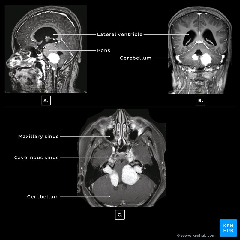 Cerebral and cerebellar tumours - T1 MRI