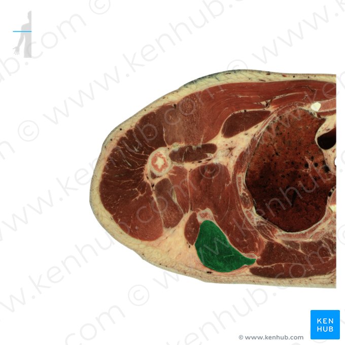 Infraspinatus muscle (Musculus infraspinatus); Image: National Library of Medicine