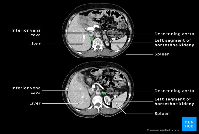 Adrenal glands (green) in a patient with a horseshoe kidney