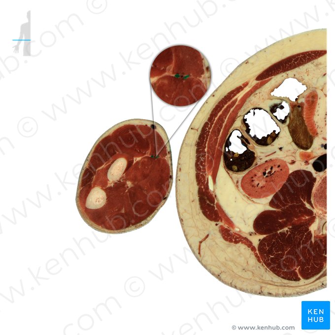 Veias radiais (Venae radiales); Imagem: National Library of Medicine