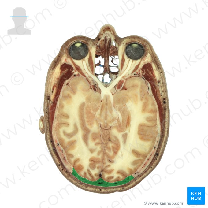Occipital bone (Os occipitale); Image: National Library of Medicine