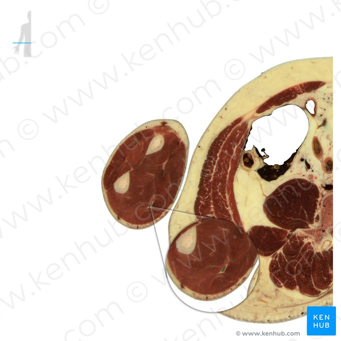 Nervo ulnar (Nervus ulnaris); Imagem: National Library of Medicine