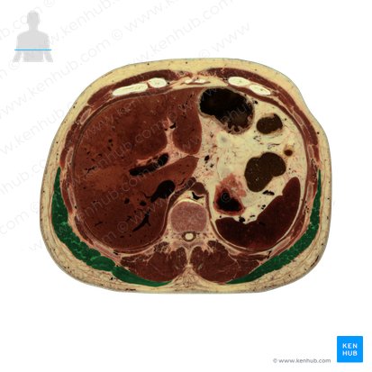 Músculo latíssimo do dorso (Musculus latissimus dorsi); Imagem: National Library of Medicine