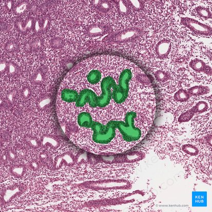 Tortuous endometrial glands; Image: 