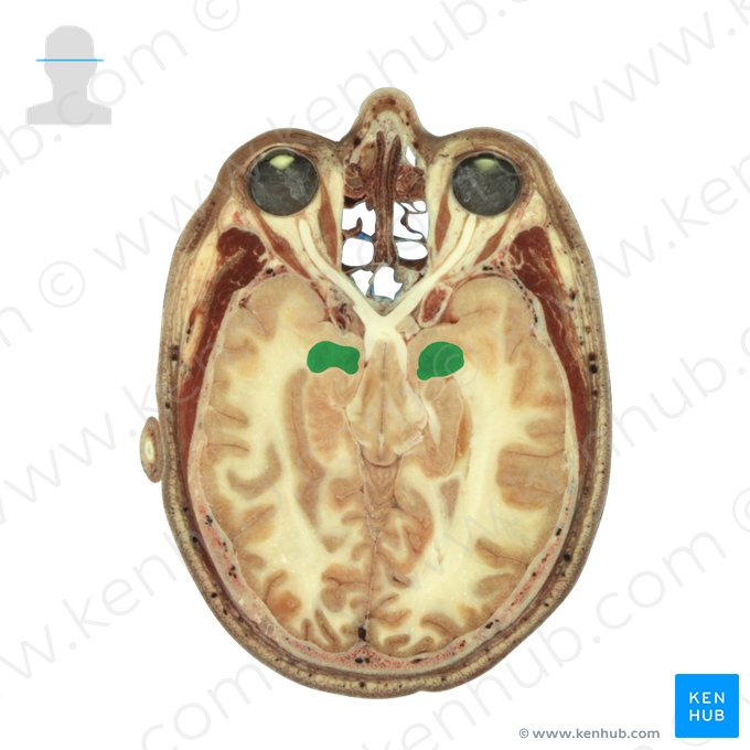 Corpus amygdaloideum (Mandelkern); Bild: National Library of Medicine