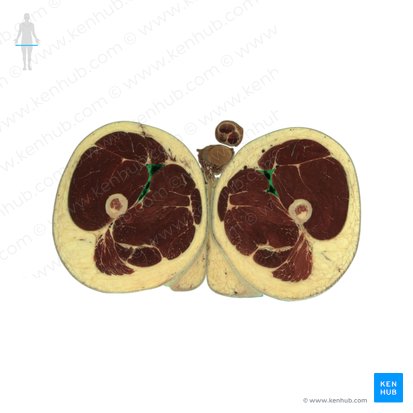 Adductor canal (Canalis adductorius); Image: National Library of Medicine