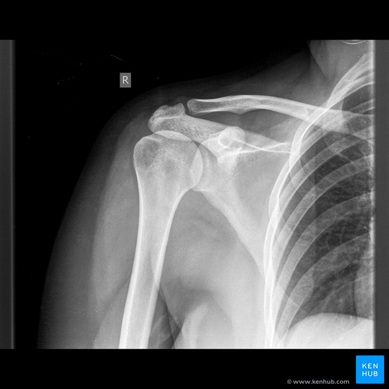 Clavicle and clavicular joint X-rays - anterior view