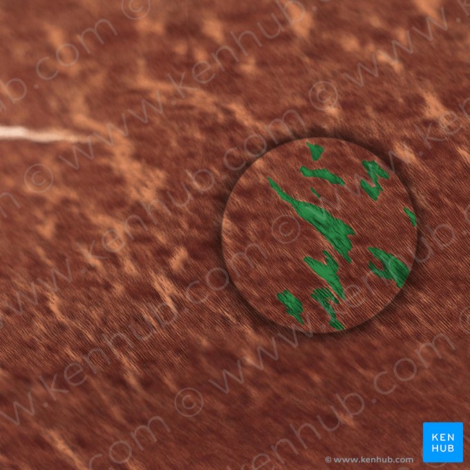 Interglobuläres Dentin; Bild: 