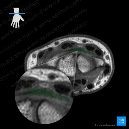 Dorsal radiocarpal ligament (Ligamentum radiocarpeum dorsale); Image: 
