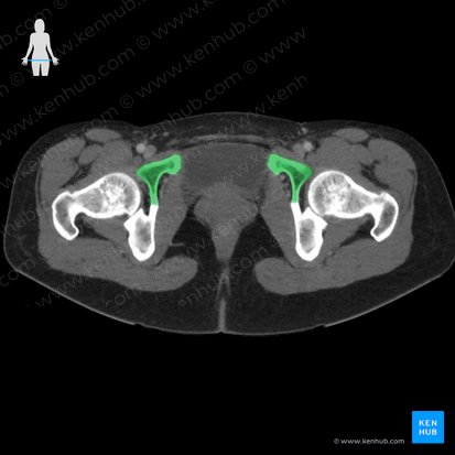 Púbis (Os pubis); Imagem: 