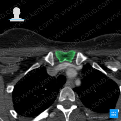 Sternum (Brustbein); Bild: 