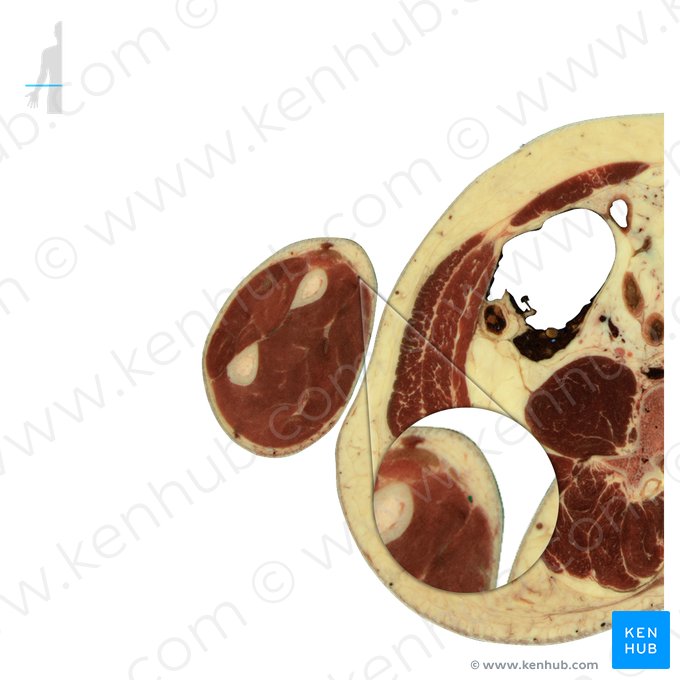 Radial artery (Arteria radialis); Image: National Library of Medicine