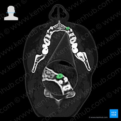 Maxillary left canine tooth (Dens caninus sinister maxillaris); Image: 