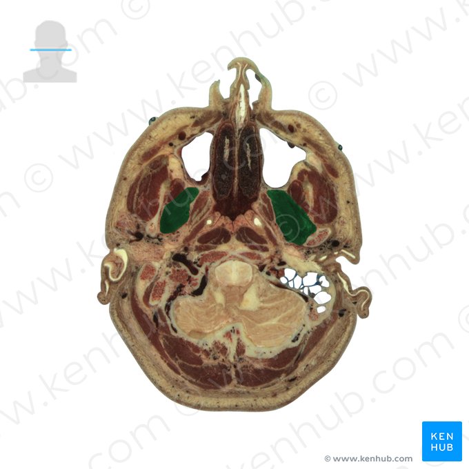 Lateral pterygoid muscle (Musculus pterygoideus lateralis); Image: National Library of Medicine