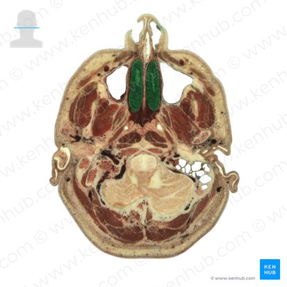 Cornete nasal inferior (Concha nasalis inferior); Imagen: National Library of Medicine