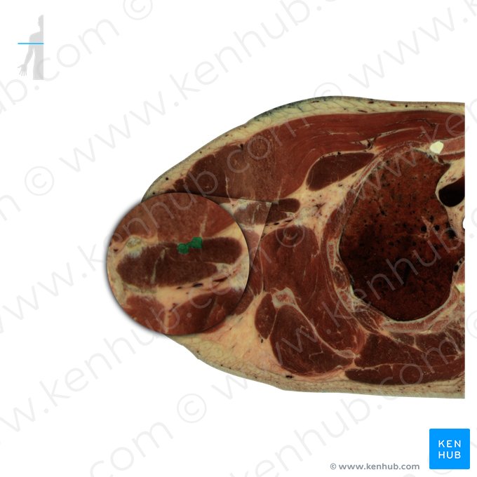 Short head of biceps brachii muscle (Caput breve musculi bicipitis brachii); Image: National Library of Medicine