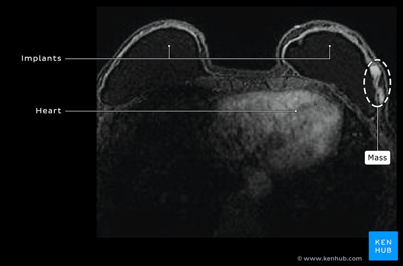 Mass in Breast - MRI