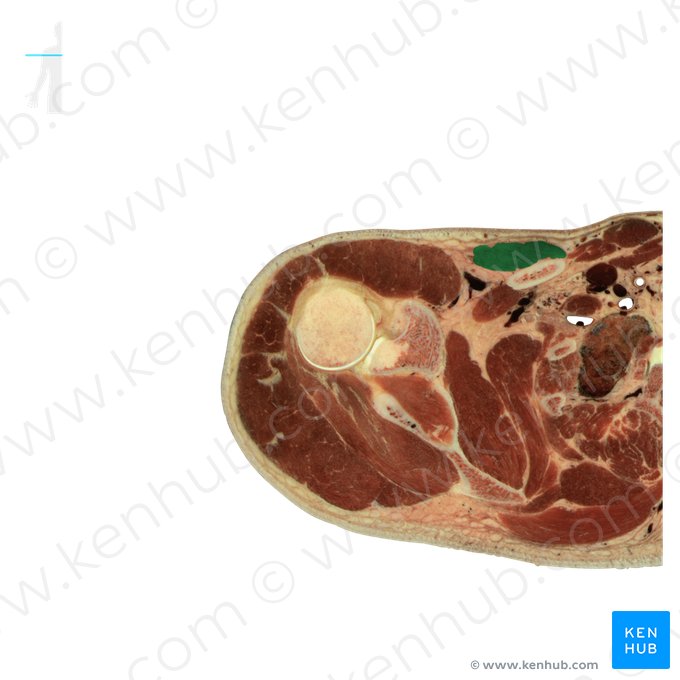 Músculo peitoral maior (Musculus pectoralis major); Imagem: National Library of Medicine
