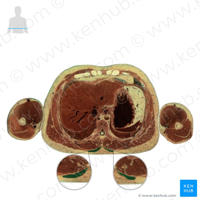 Trapezius muscle (Musculus trapezius); Image: National Library of Medicine