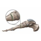 Tarsometatarsal joints