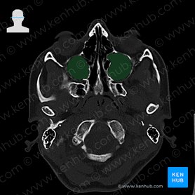 Sinus maxillaris (Kieferhöhle); Bild: 